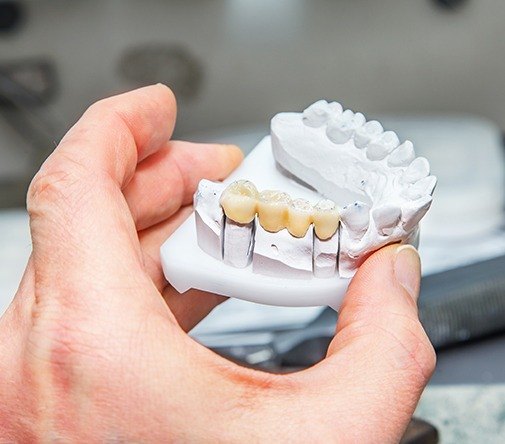 dentist holding dental bridge example