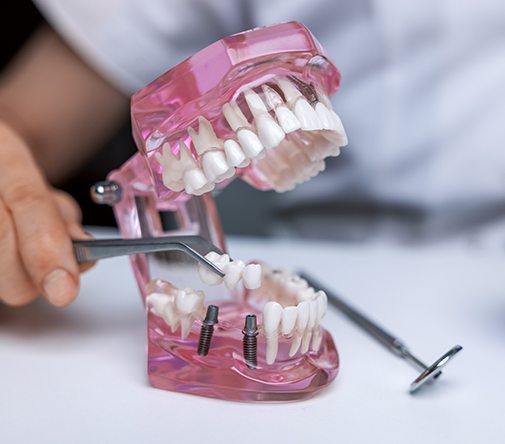 Dentist placing a model dental bridge 