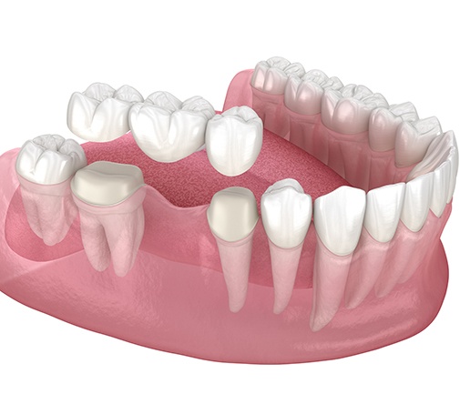 An illustration of a traditional dental bridge anchored to natural teeth 