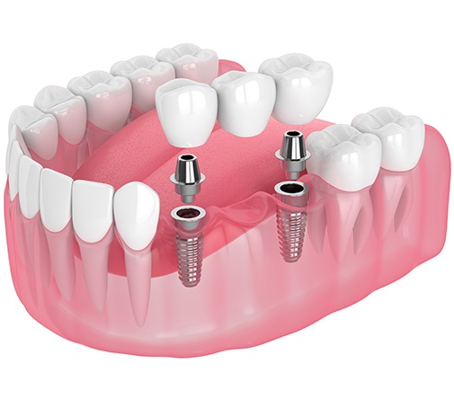An illustration of an implant-supported dental bridge 
