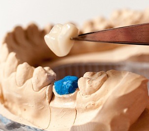 example of dental crown