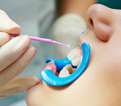 woman getting fluoride treatment