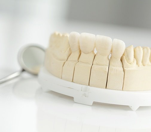 dental bridge example