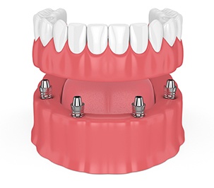 Implant-supported lower denture