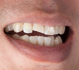 close shot of chipped tooth