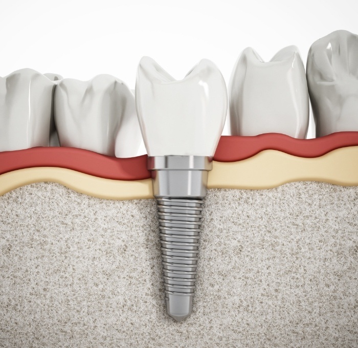 computer illustration of implant