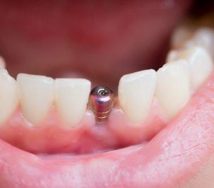 metal part of implant in smile