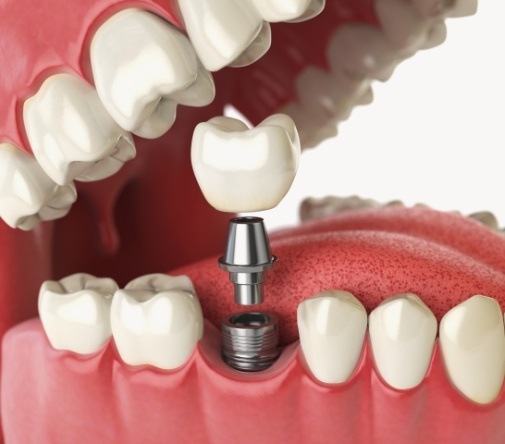 computer illustration of implant being placed in smile