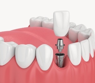 computer illustration of single implant