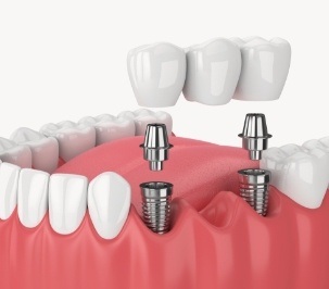 computer illustration of multiple implants