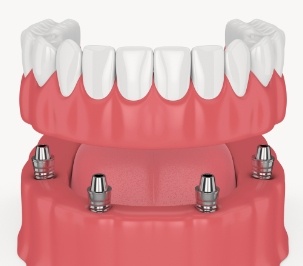 computer illustration of implant dentures