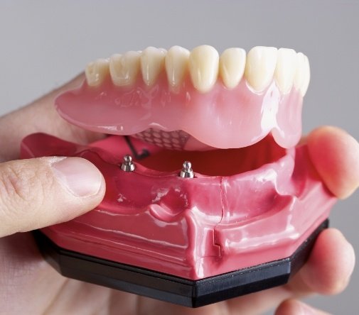 implant retained denture example