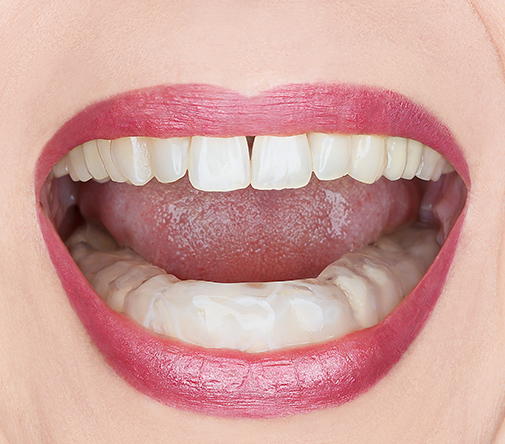 woman's mouth with mouthguard in