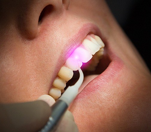 soft tissue laser behind tooth