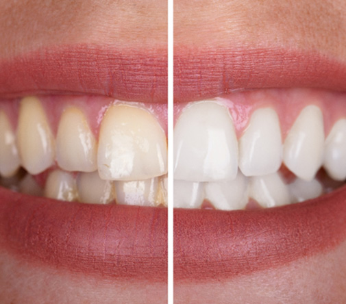 Closeup of patient's teeth before and after teeth whitening