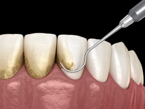 plaque and tartar buildup around the gum line