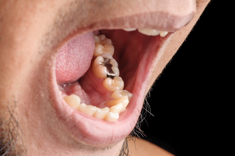 man with tooth fillings in Marysville