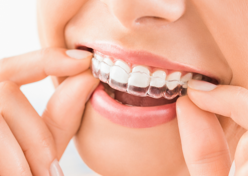 Woman fitting clear Invisalign retainer