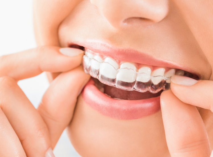 Woman putting on clear aligner